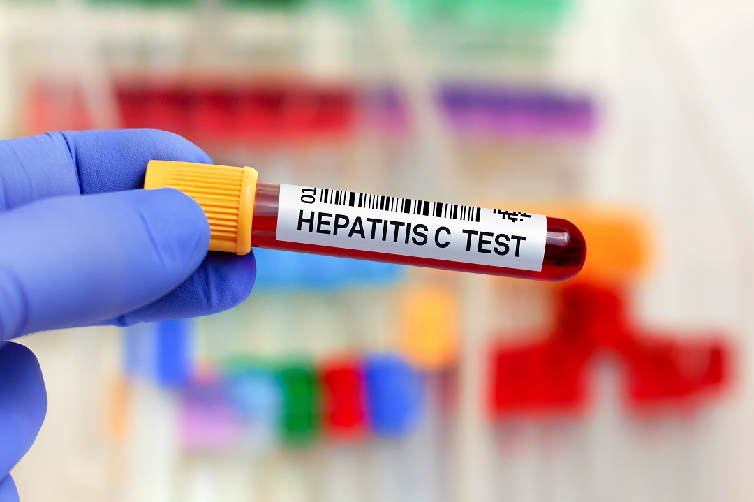 Infermiere contrae Epatite C senza contatto con sangue. Riconosciuta malattia professionale